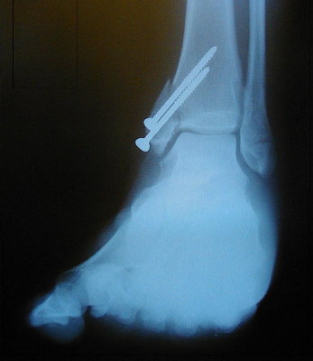 Gordon's foot - with broken ankle and 2 pins